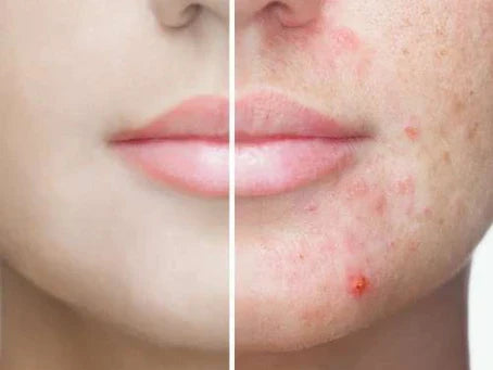 טיפול באקנה